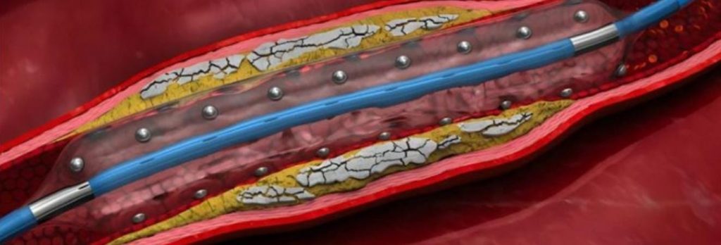 Sistem LithiX HC-IVL (Hertz Contact Intravascular Lithotripsy), yang dikembangkan oleh Elixir Medical Corporation.